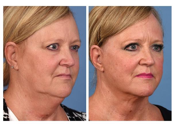 Real patient before-and-after photo